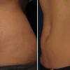Striae olie