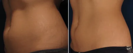 Striae olie